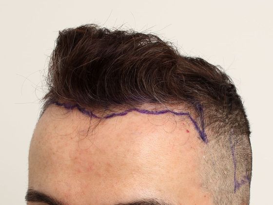 Male Before And After Hair Transplant Photos Hairline FUE (15) - Before