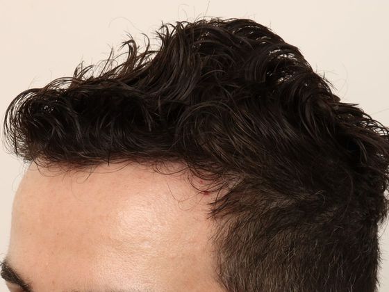 Male Before And After Hair Transplant Photos Hairline FUE (15) - After