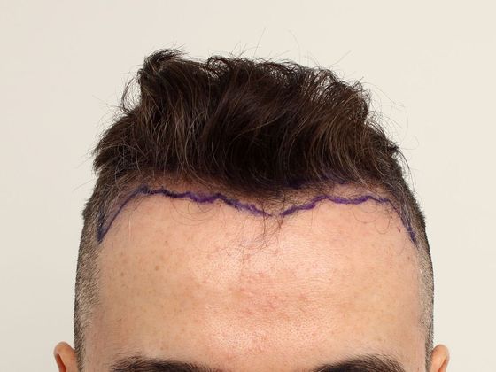 Hair Transplant - Male: Hairline FUE - Case 15 - Before FUE hair transplant