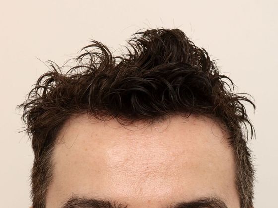 Hair Transplant - Male: Hairline FUE - Case 15 - After FUE hair transplant
