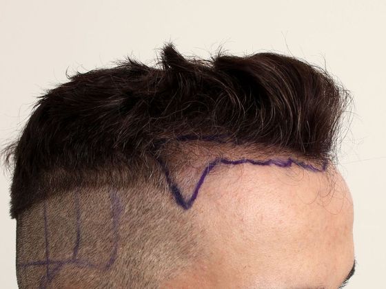 Hair Transplant - Male: Hairline FUE - Case 15 - Before FUE hair transplant