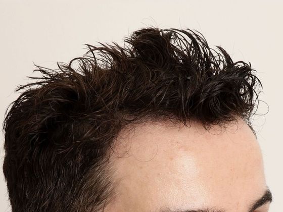 Hair Transplant - Male: Hairline FUE - Case 15 - After FUE hair transplant