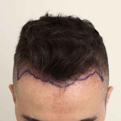 Hair Transplant - Male: Hairline FUE - Case 15 - Before