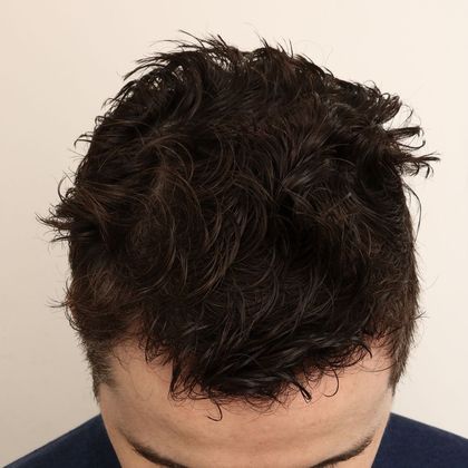 Hair Transplant - Male: Hairline FUE - Case 15 - After