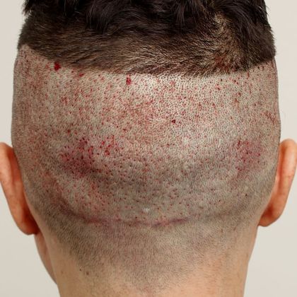 Hair Transplant - Male: Hairline FUE - Case 15 - Post-op FUE hair transplant