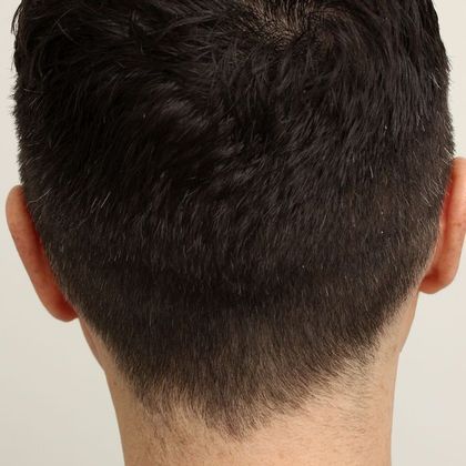 Hair Transplant - Male: Hairline FUE - Case 15 - 4 months after FUE hair transplant