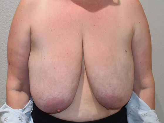 Breast Reduction: Case 127 - Before
