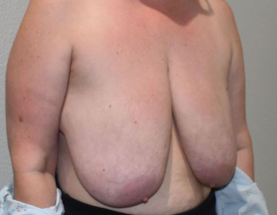 Breast Reduction: Case 127 - Before