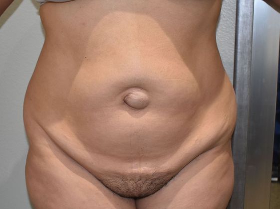 Tummy Tuck (Abdominoplasty): Case 324 - Before