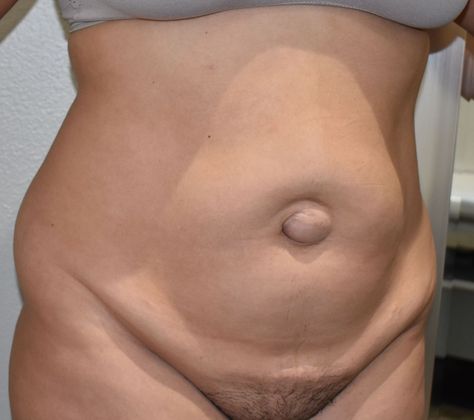 Tummy Tuck (Abdominoplasty): Case 324 - Before