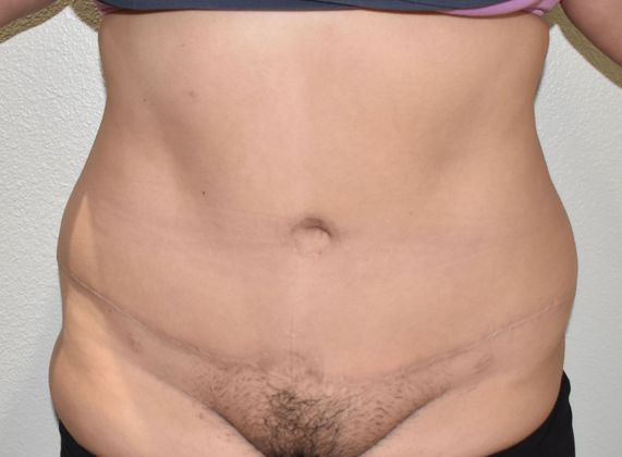 Tummy Tuck (Abdominoplasty): Case 324 - After