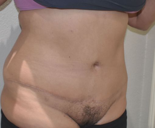 Tummy Tuck (Abdominoplasty): Case 324 - After