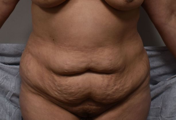 Tummy Tuck (Abdominoplasty): Case 325 - Before