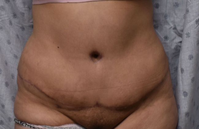 Tummy Tuck (Abdominoplasty): Case 325 - After