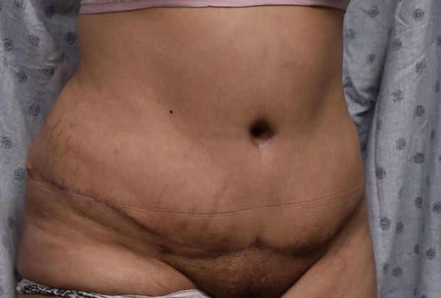 Massive Weight Loss : Case 91 - After