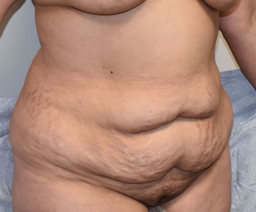 Massive Weight Loss : Case 91 - Before