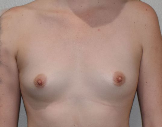 Breast Augmentation w/ Lift: Case 406 - Before