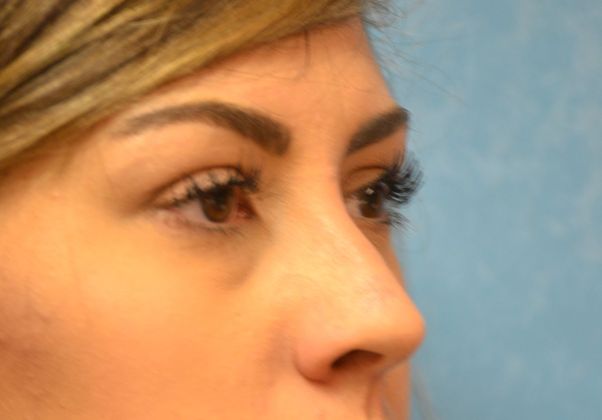 Rhinoplasty Case 1410- Perrysburg, OH - Before