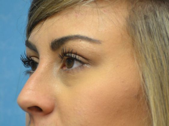 Rhinoplasty: Case 1410- Perrysburg, OH - Before