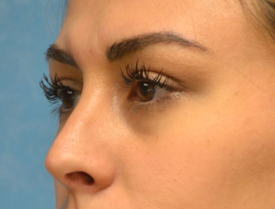 Rhinoplasty: Case 1410- Perrysburg, OH - After