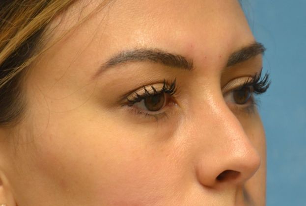 Rhinoplasty Case 1410- Perrysburg, OH - After