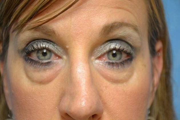 Eye Lift (Blepharoplasty) Case 1573- Temperance, MI - Before