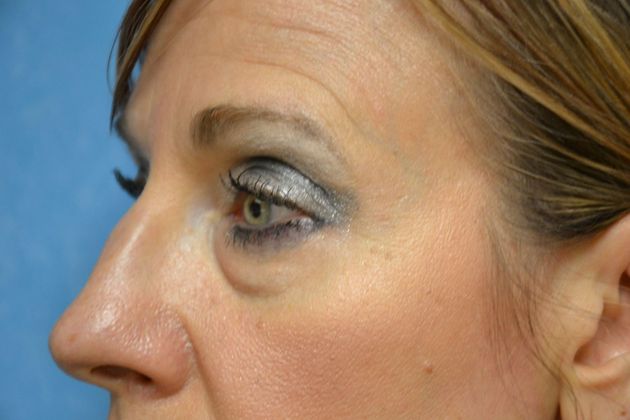 Eye Lift (Blepharoplasty): Case 1573- Temperance, MI - Before