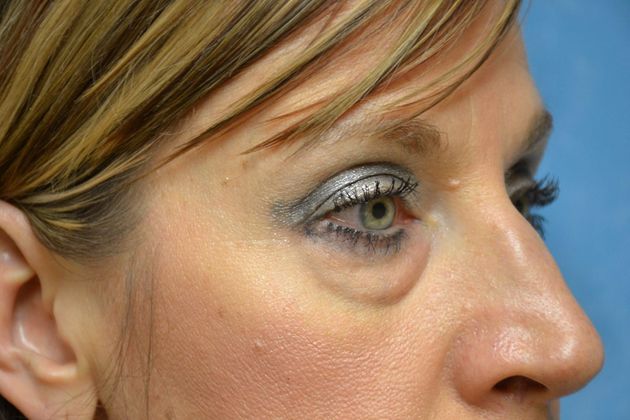 Eye Lift (Blepharoplasty): Case 1573- Temperance, MI - Before