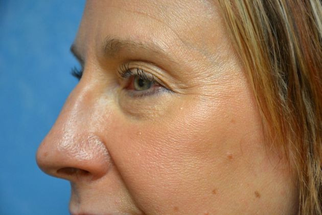 Eye Lift (Blepharoplasty): Case 1573- Temperance, MI - After