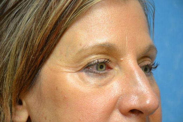 Eye Lift (Blepharoplasty): Case 1573- Temperance, MI - After