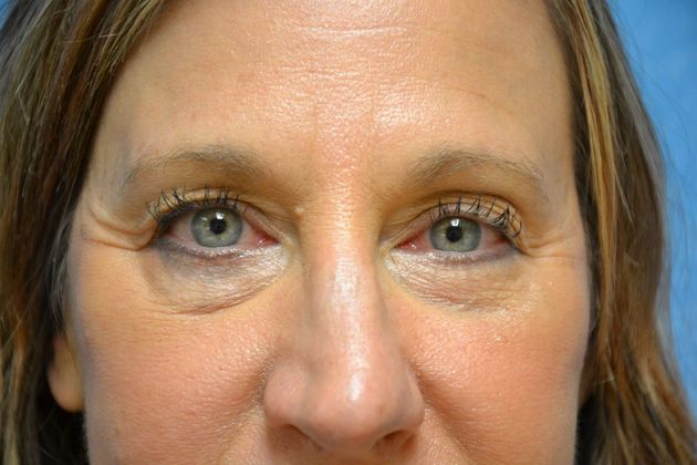 Eye Lift (Blepharoplasty) Case 1573- Temperance, MI - After