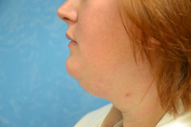 Liposuction: Case 1700- Toledo, OH - Before