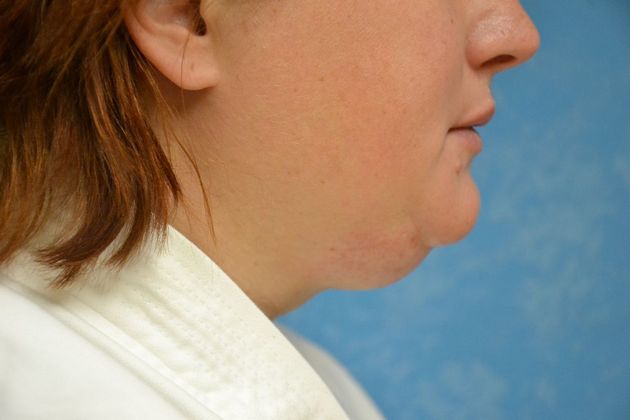 Liposuction: Case 1700- Toledo, OH - Before