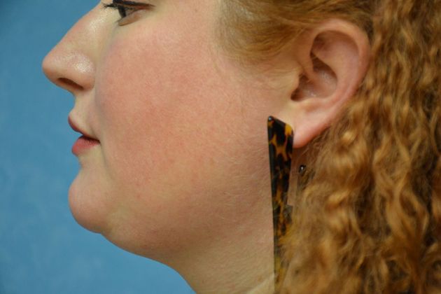 Liposuction: Case 1700- Toledo, OH - After