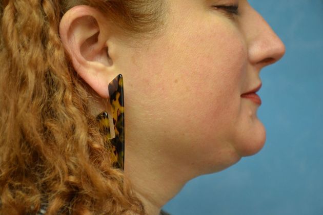 Liposuction: Case 1700- Toledo, OH - After