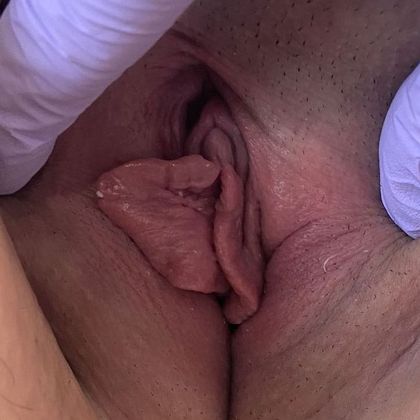 Labiaplasty Case 25 Labiaplasty, Scarsdale, NY - Before