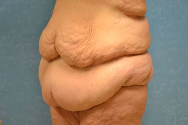 Bodylift: Case 1528- Findlay, OH - Before