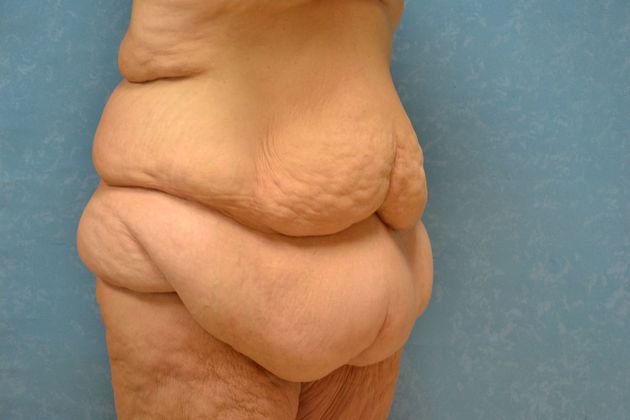 Bodylift: Case 1528- Findlay, OH - Before