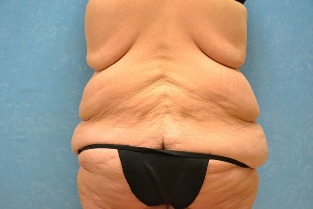 Bodylift: Case 1528- Findlay, OH - Before