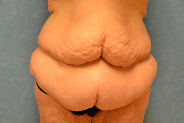 Bodylift Case 1528- Findlay, OH - Before