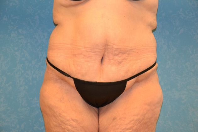 Bodylift Case 1528- Findlay, OH - After