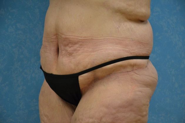 Bodylift: Case 1528- Findlay, OH - After