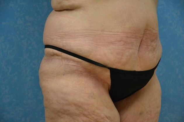 Bodylift: Case 1528- Findlay, OH - After