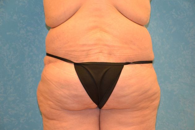 Bodylift: Case 1528- Findlay, OH - After