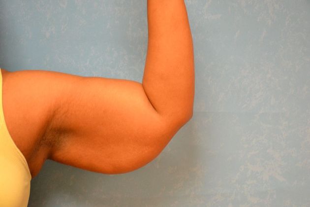 Arm Lift: Case 1510- Toledo, OH - Before