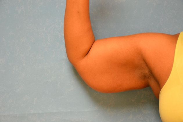 Arm Lift Case 1510- Toledo, OH - Before