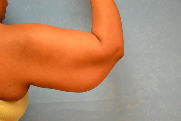 Arm Lift: Case 1510- Toledo, OH - Before