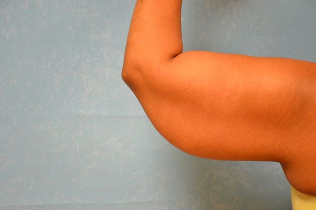 Arm Lift: Case 1510- Toledo, OH - Before