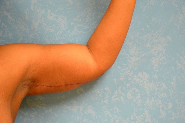 Arm Lift: Case 1510- Toledo, OH - After