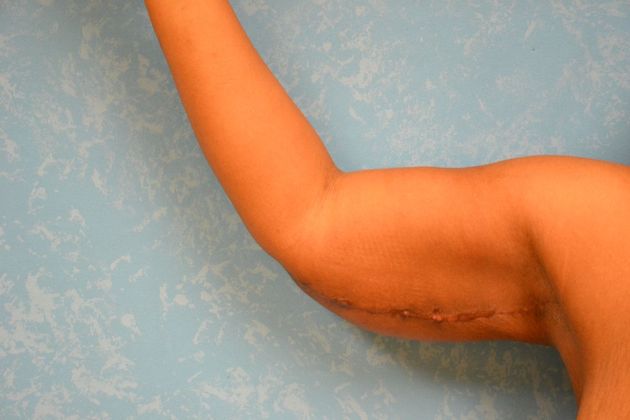 Arm Lift Case 1510- Toledo, OH - After